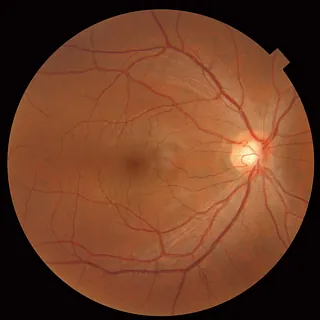 eye health